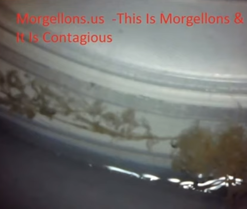 What Is Morgellons Disease Is Not A Disease, It Is A Infestation Of The Human Body – Oct 1, 2014